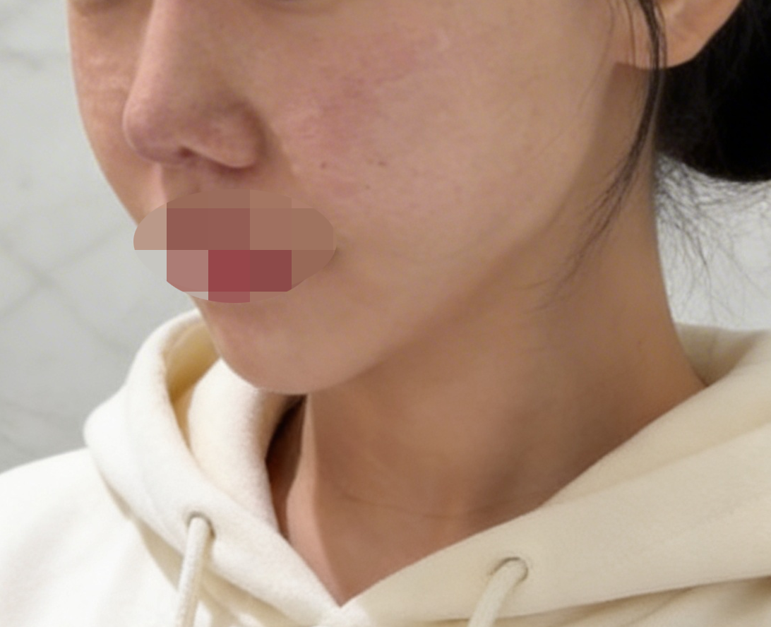 모공 늘어지고 피부결 거칠어진 것 같아서 리쥬란 받으러 방문했어요!