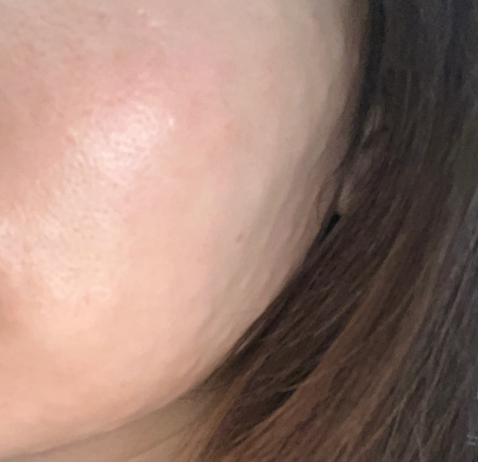 일본에서 방문해서 받은 리쥬란 힐러, 진행 속도까지 마음에 들었어요~!!