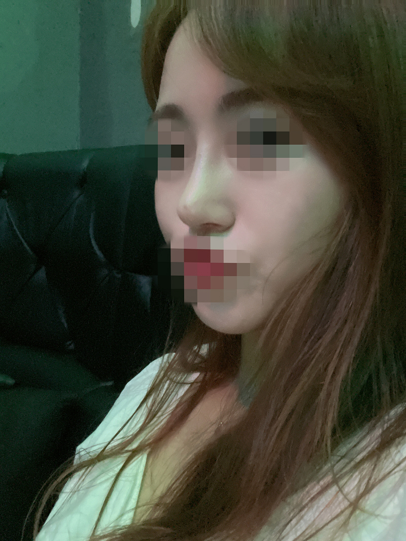 수술2달차 후기 지금은 완전히 제코 같아요 너무 만족하고 지내고 있어요~