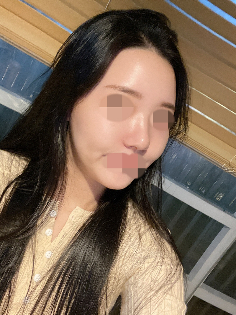 많은 후기가 보장하듯 많은수술 경험이있으셔서 믿고 수술결정 했어요.