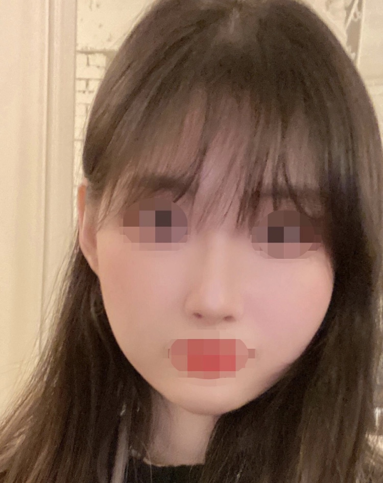 코수술 만족해요