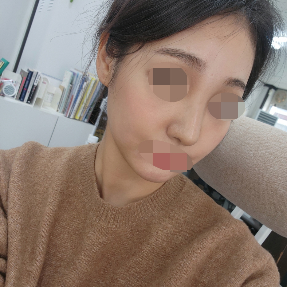 눈밑지랑 코 했는데 삶의 질이 달라졌어요!