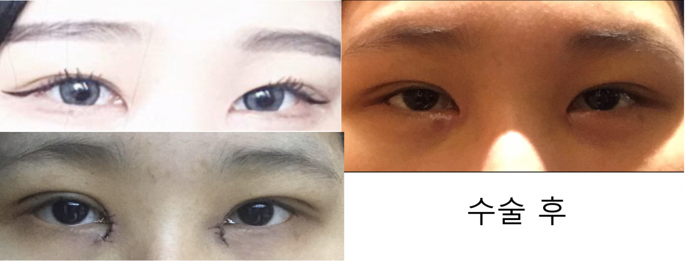 쌍수후기