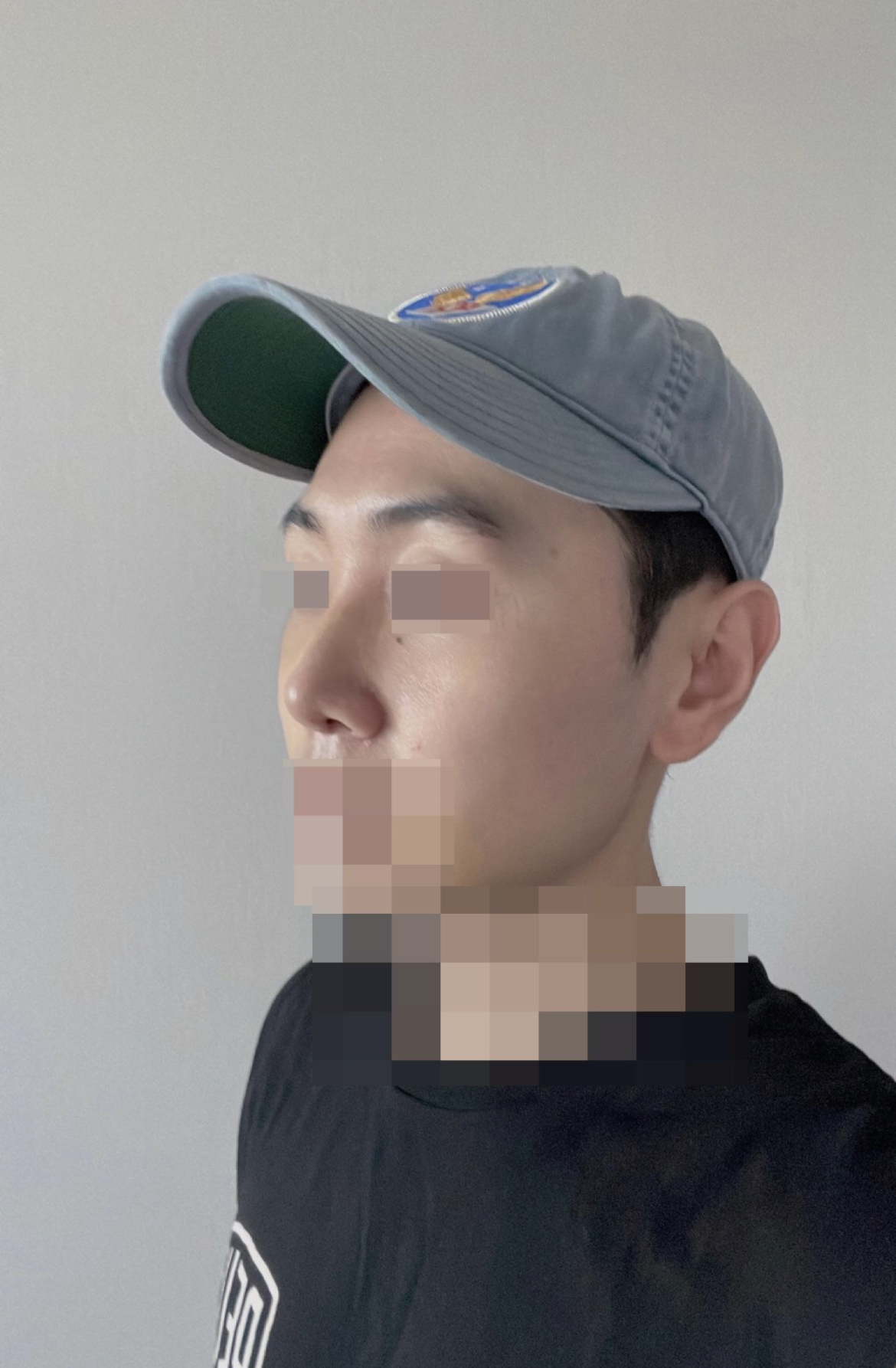 이제는 자신감 있는 코로 살아갈수 있을거같아요!