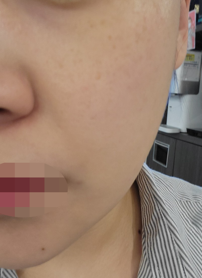 써마지 받고 나니 라인이 정리된 것 같아서 재방문 의사 있어요~