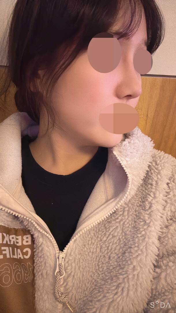 제 후기글 보시고 병원 잘 선택하셔서 코재수술은 없었으면 좋겠습니다!