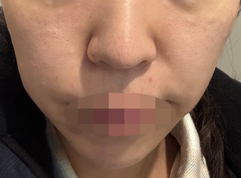 피부 처져서 써마지 받았는데 친절하고 좋은 것 같아요 ㅎㅎ