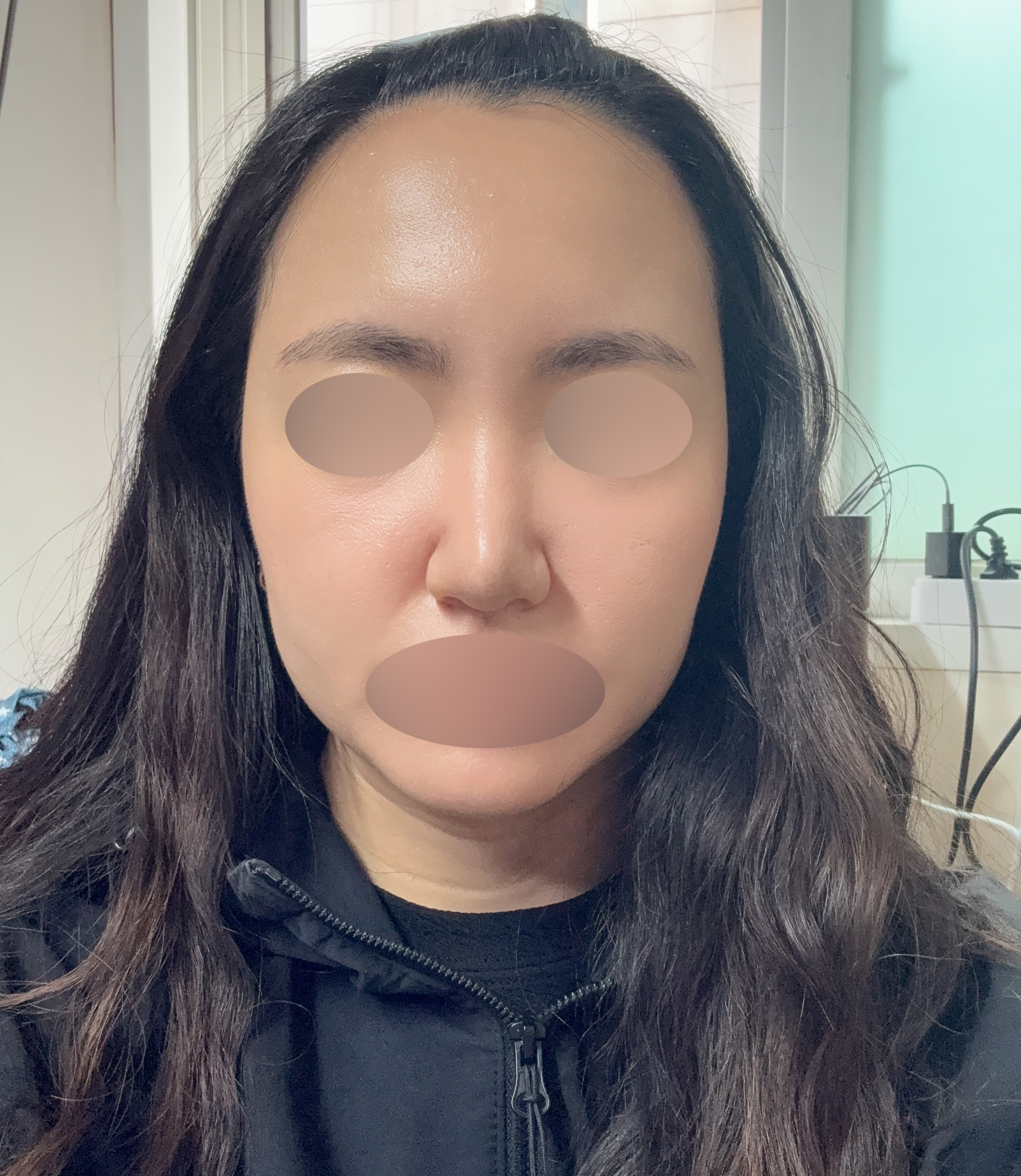 복코 수술 1달차, 변화가 보이기 시작했어요