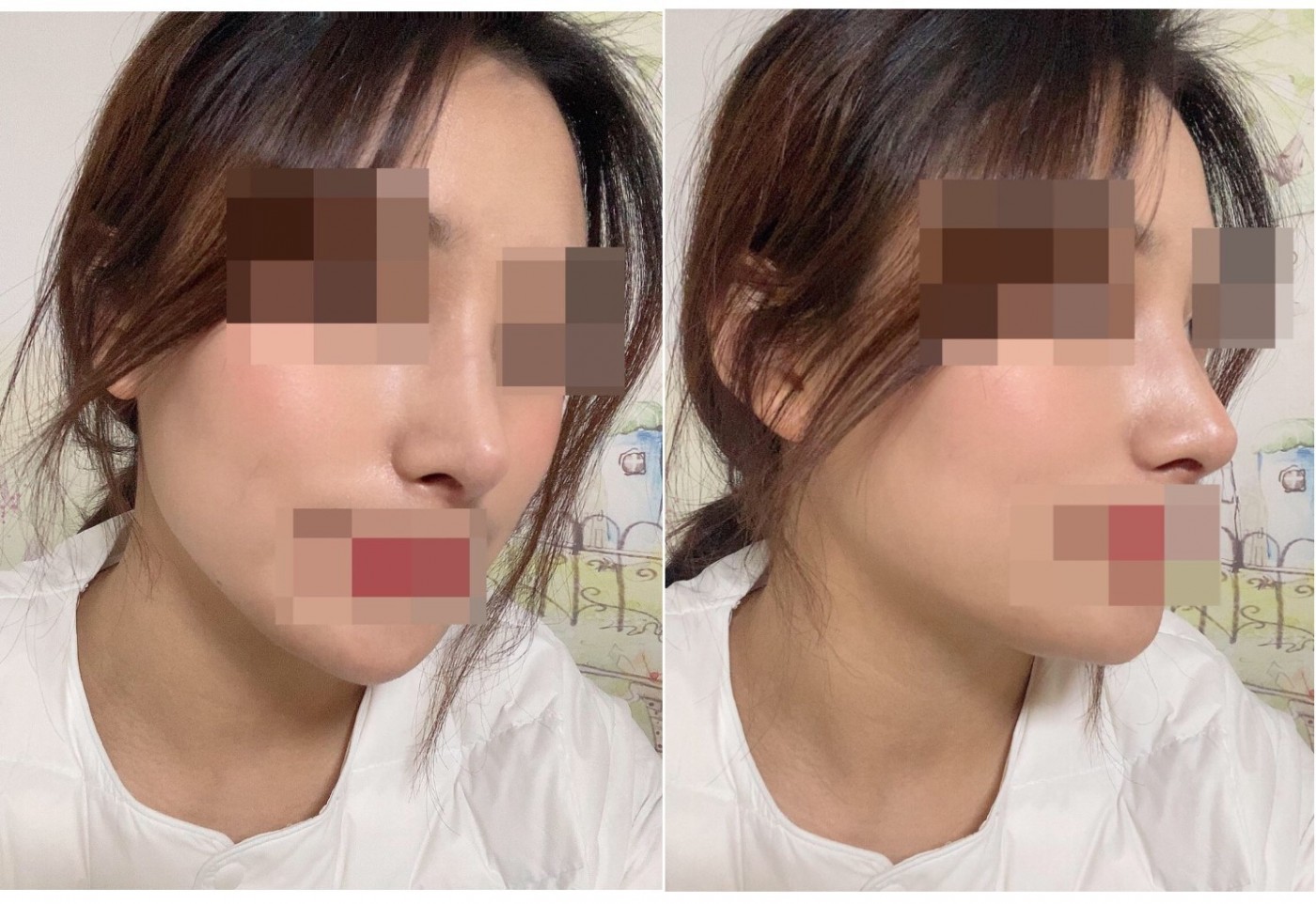 매부리 수술후기입니다