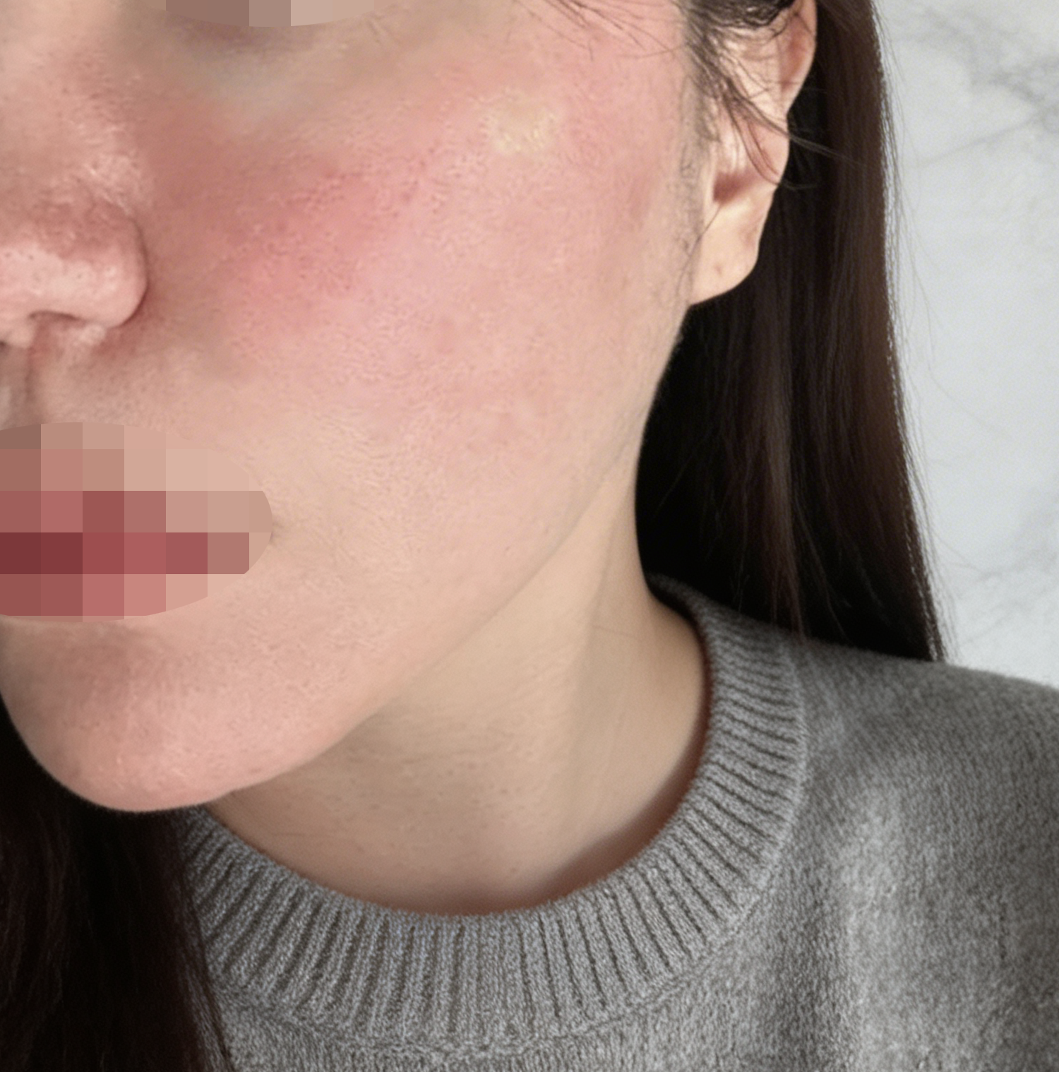 포텐자랑 울쎄라 한번에 받았는데 수면이라 아프지 않고 좋았어요!