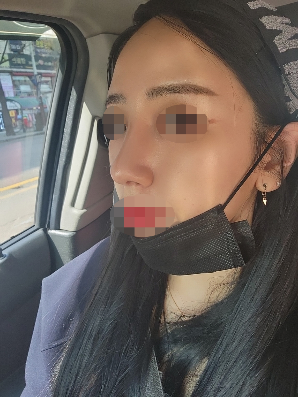 코수술을 20대부터 생각하고있었어요~~~ 수술한지는 이제 2주차입니다