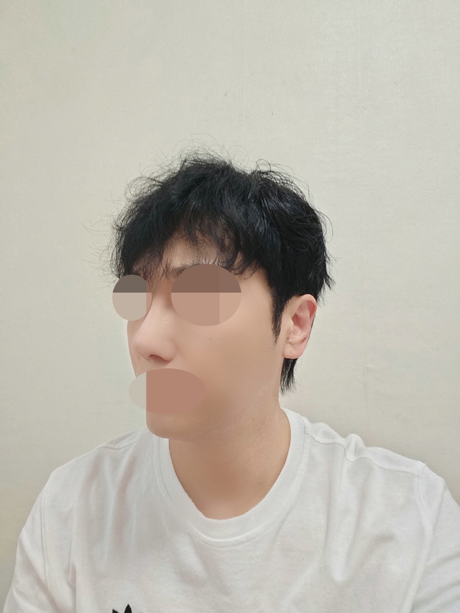 원장님 인상이 좋았던 만큼 제 코도 예쁘게 재수술 해주셨습니다~