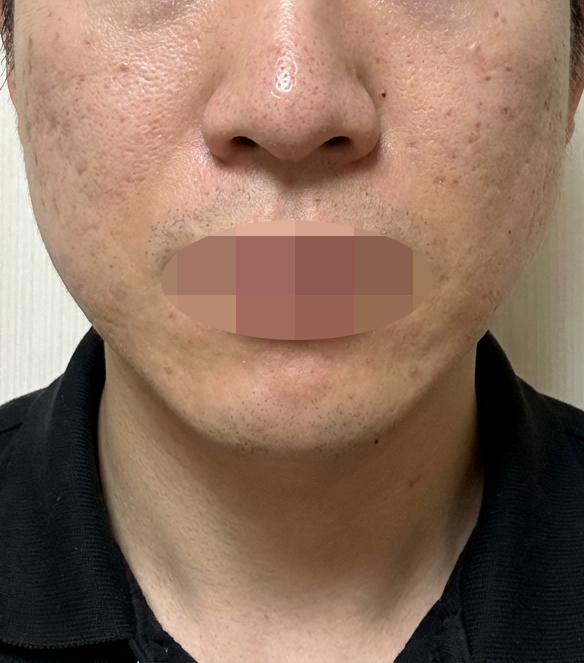 탄력 떨어지는 게 느껴져서 지인 추천으로 리쥬란 드디어 받아봤습니다~