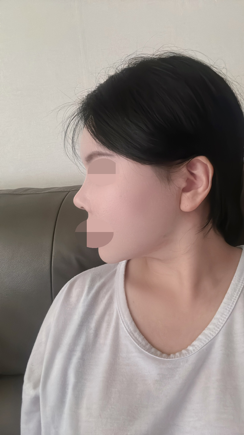 콧대와 코끝을 예쁘게 만들어 주셨어요
