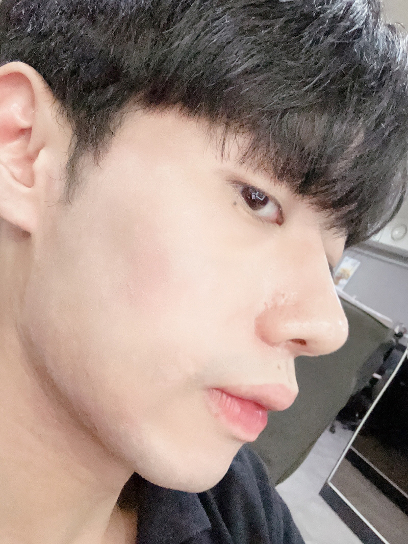 최웅규 원장님한테 상담 후 수술했는데 설명해주신 것처럼 너무 만족하고 있어요