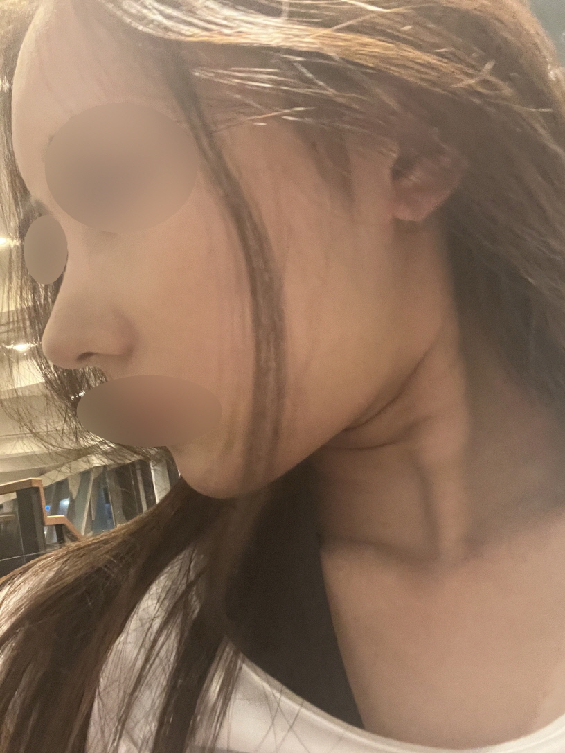 이런게 실력인가 할 정도로 저는 붓기랑 멍이 없었고 효과 톡톡히 보고 있어용!