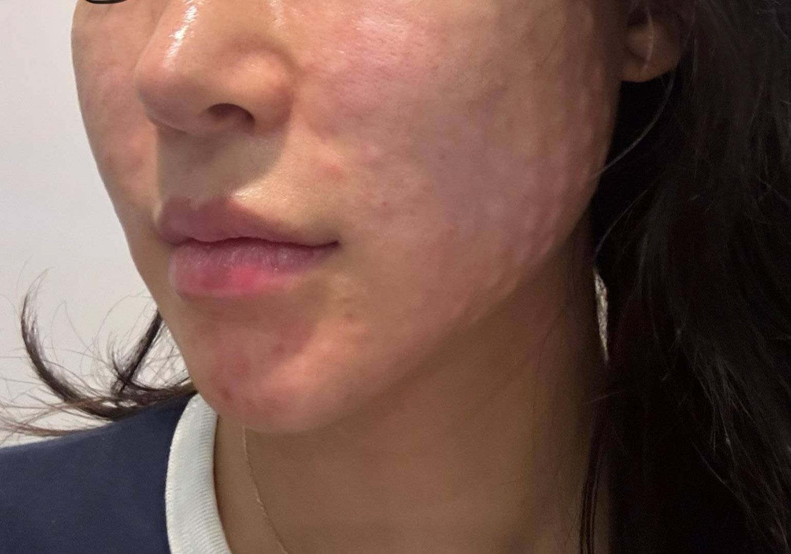 친절한 상담에 확실한 엠보까지, 리쥬란 가성비 최고예요~