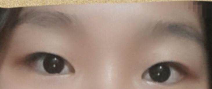 앞트임, 자연유착