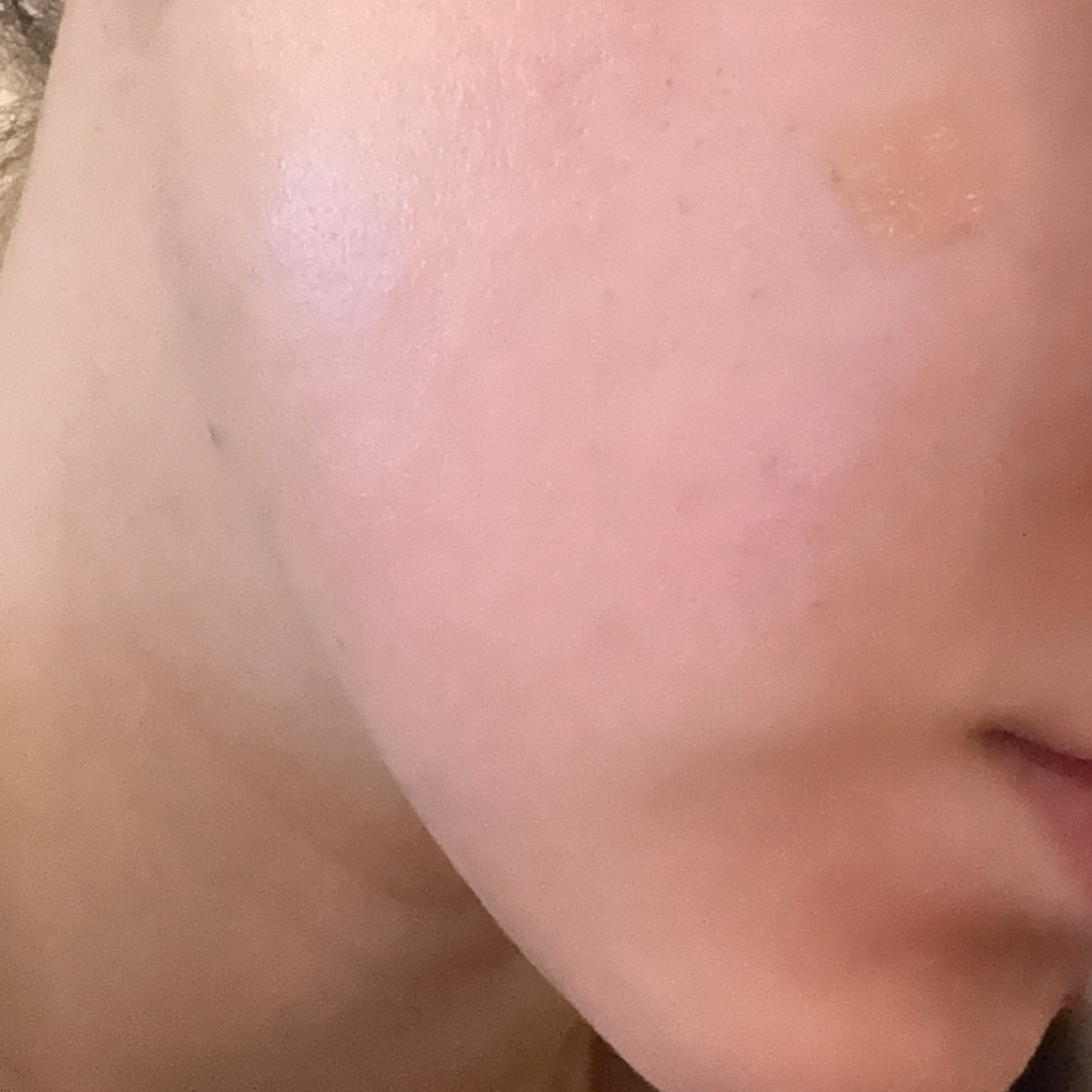 휴에 엑소좀이랑 리투오 같이 받고 왔어요, 효과 기대 중