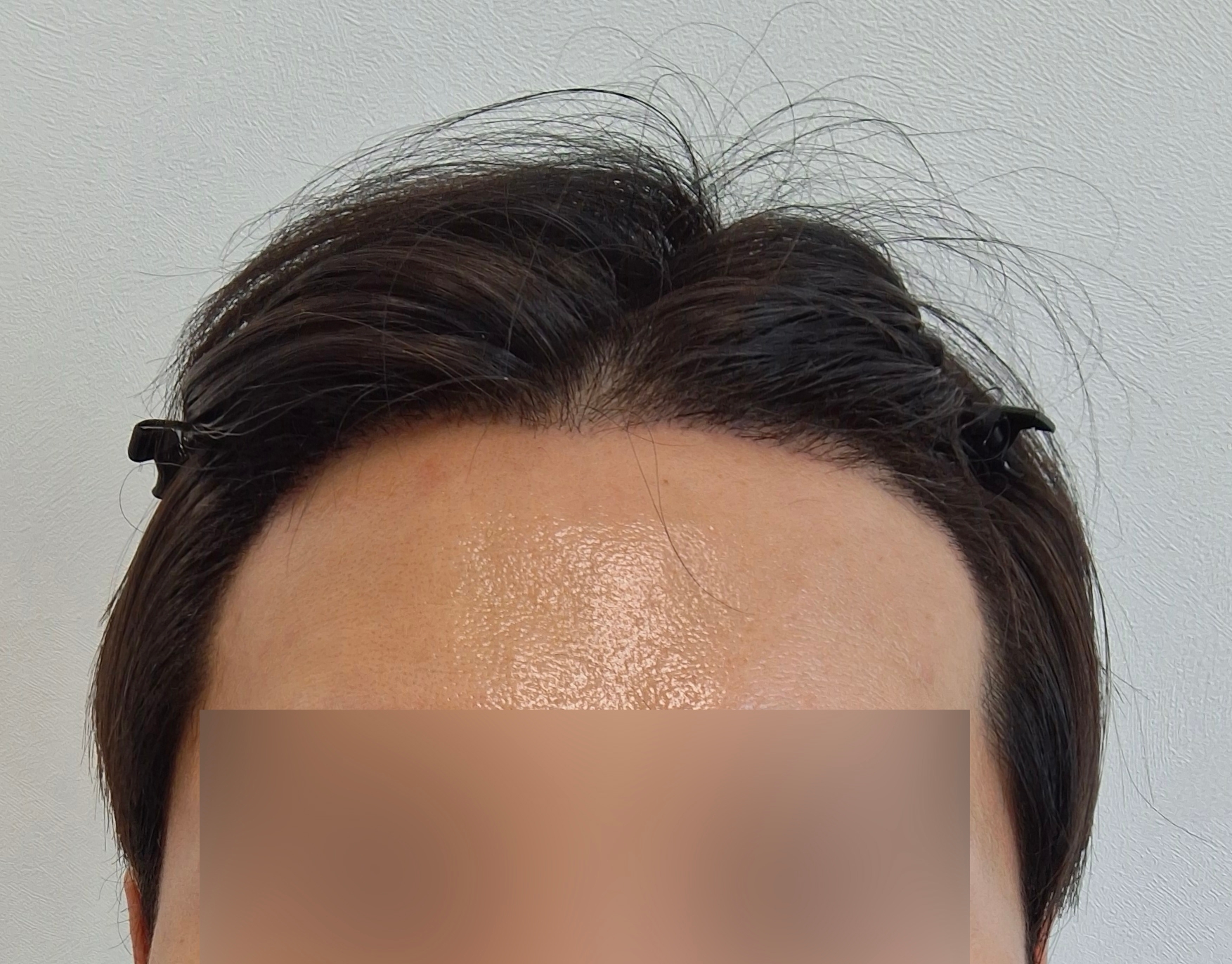 절개모발이식 2주차, 헤어라인 모양 만족중입니다
