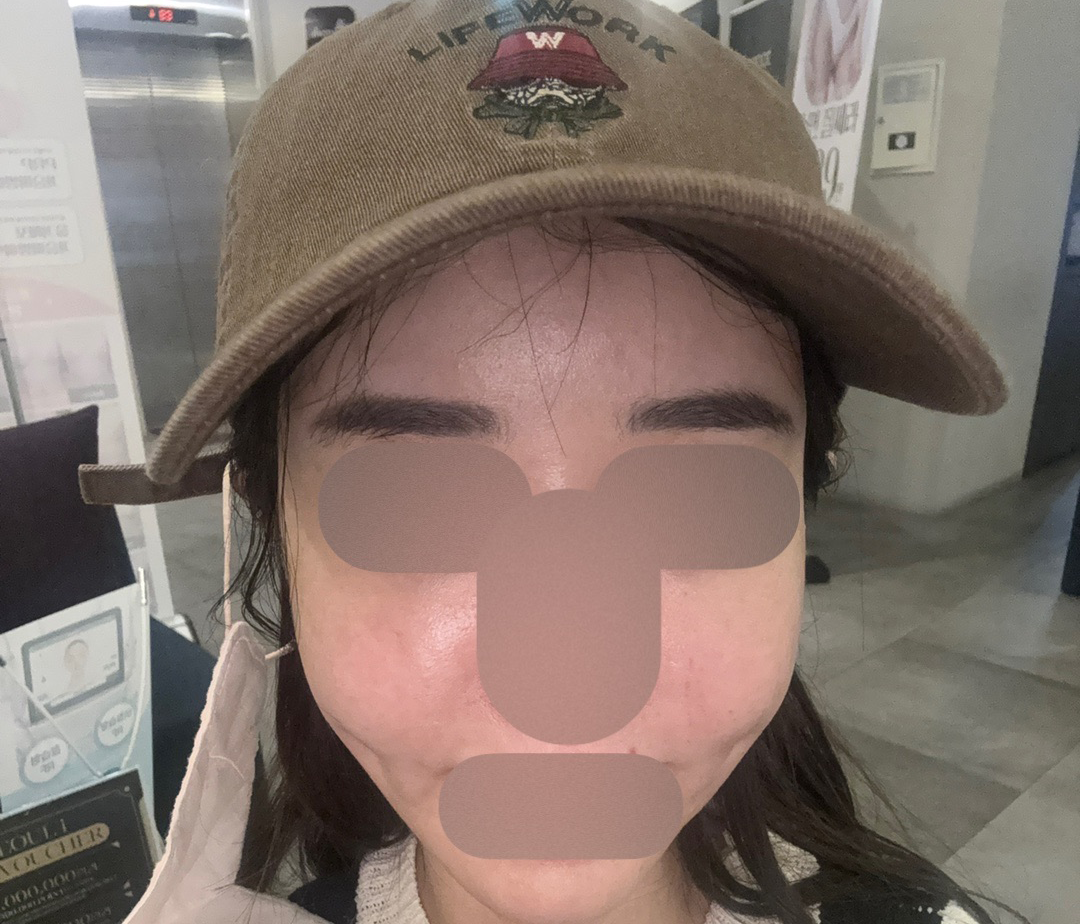 일주일에 한 번 받는데 인모드로 바로 얼굴 작아져서 가성비 갑이에요!