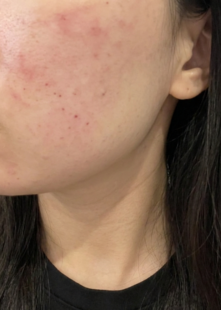 엠보 촘촘하게 잘 올라온 리쥬란, 다음에도 또 방문할 예정이에요ㅎㅎ