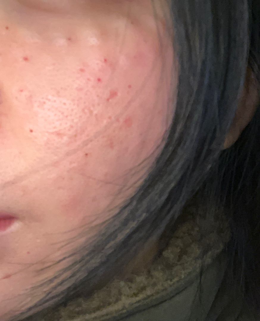 흉터모공 고민으로 받았는데 만족해서 또 올 것 같아요!