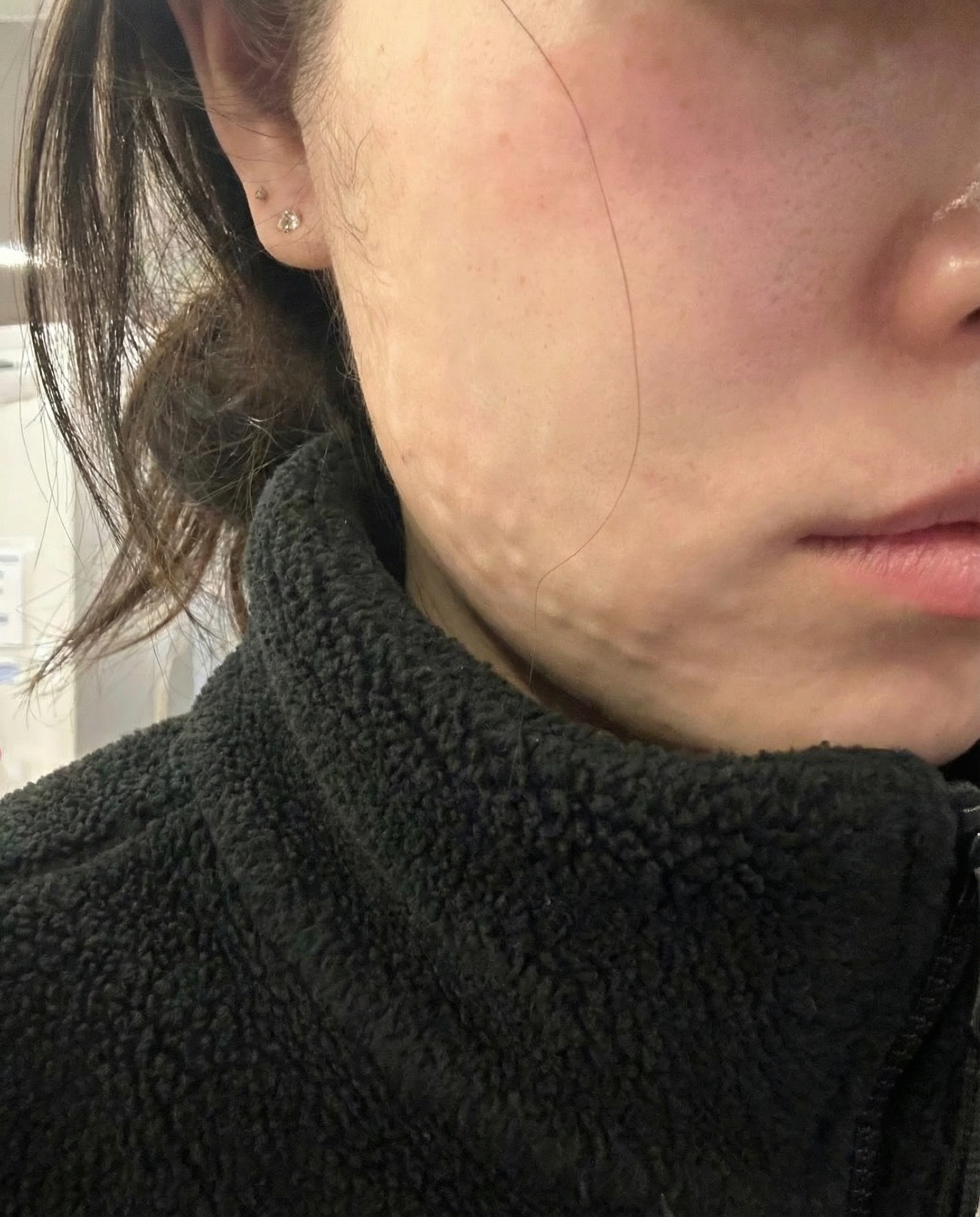대기시간 있어도 올 만한 곳! 리쥬란 받고 왔어요