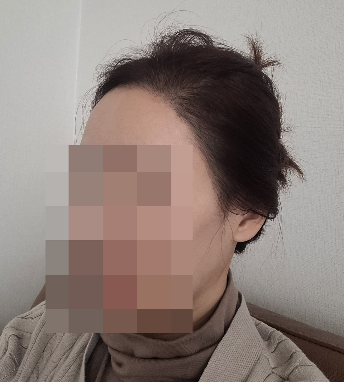 절개 모발이식 3개월차 :) 상처도 깔끔하게 잘 아물었습니당