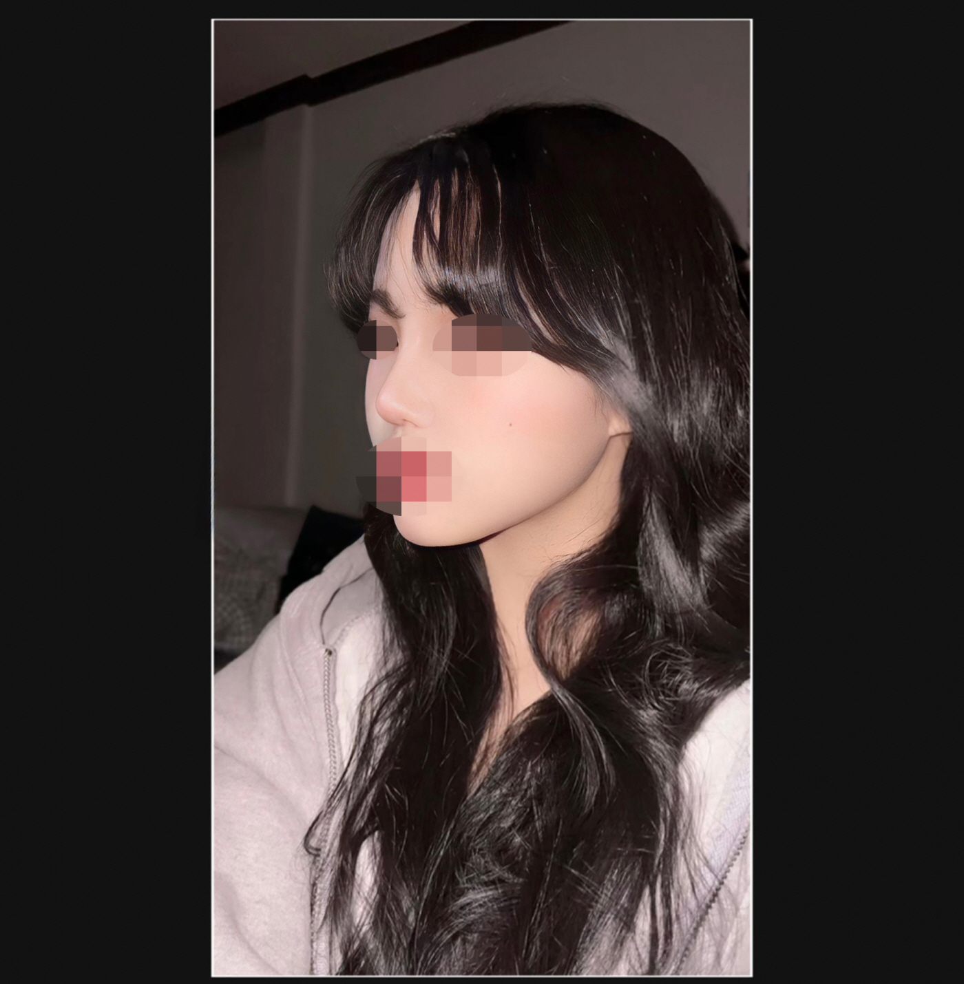 지금은 큰붓기는 아예 다 빠져서 아주아주아주 자연스러워요!