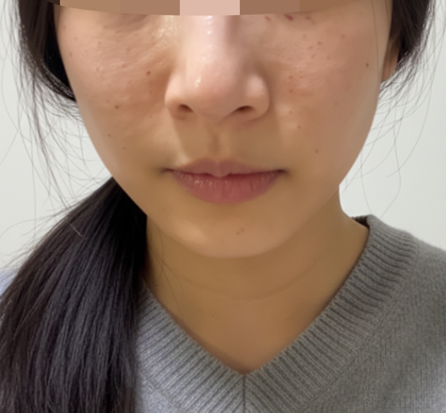 꼼꼼한 시술에 너무 만족! 리쥬란 잘 받고 왔어요