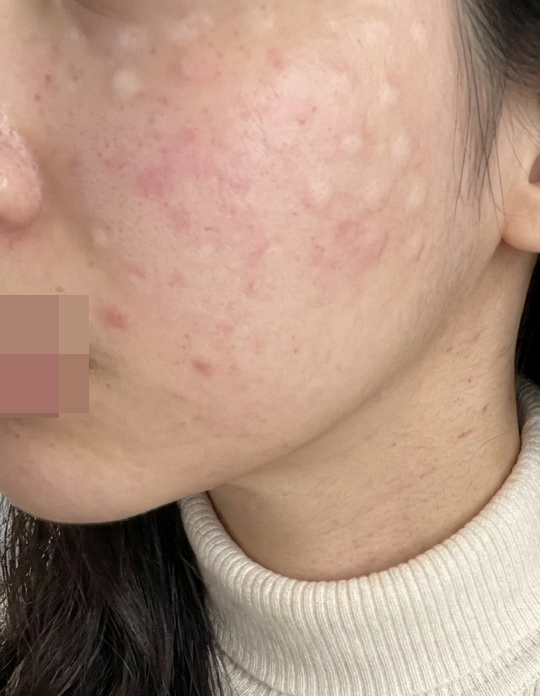 칙칙함이랑 모공·속건조 고민으로 시작한 리쥬란, 결심하길 잘했어요!