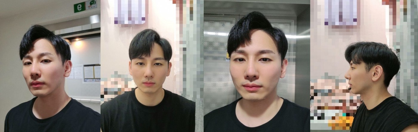 남자 눈 코 후기입니