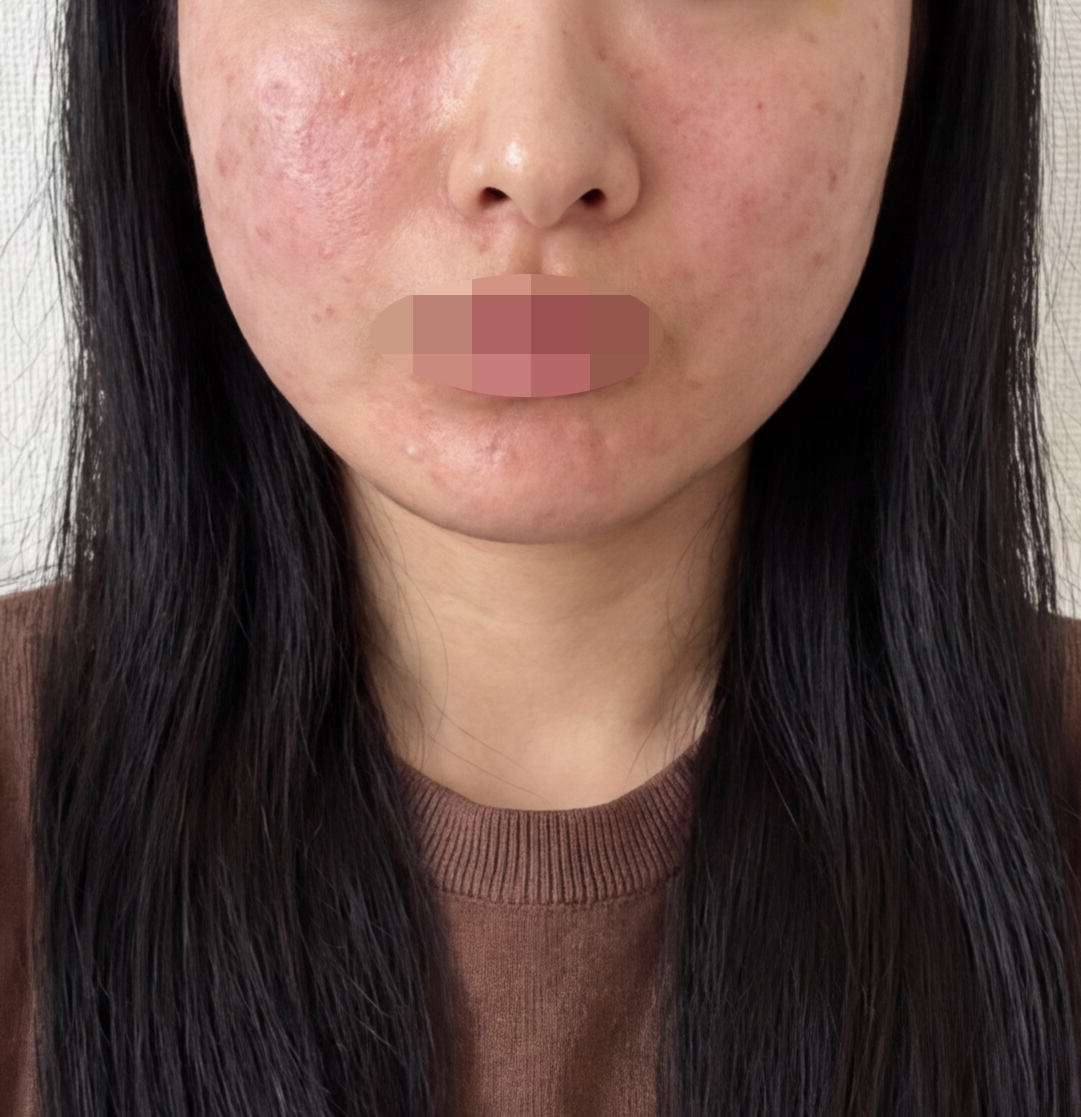 계절 바뀌자마자 피부 당김 심해져서 PRP 받았습니다~