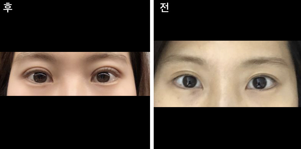 박원장님 쌍커풀 후기입니당★