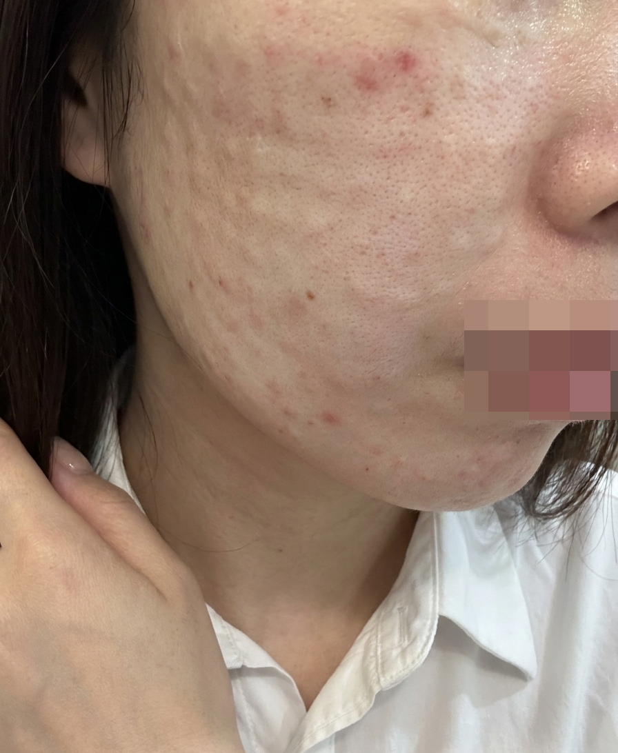 일본어 가능한 스태프까지! 안심하고 받은 리쥬란 후기예요~