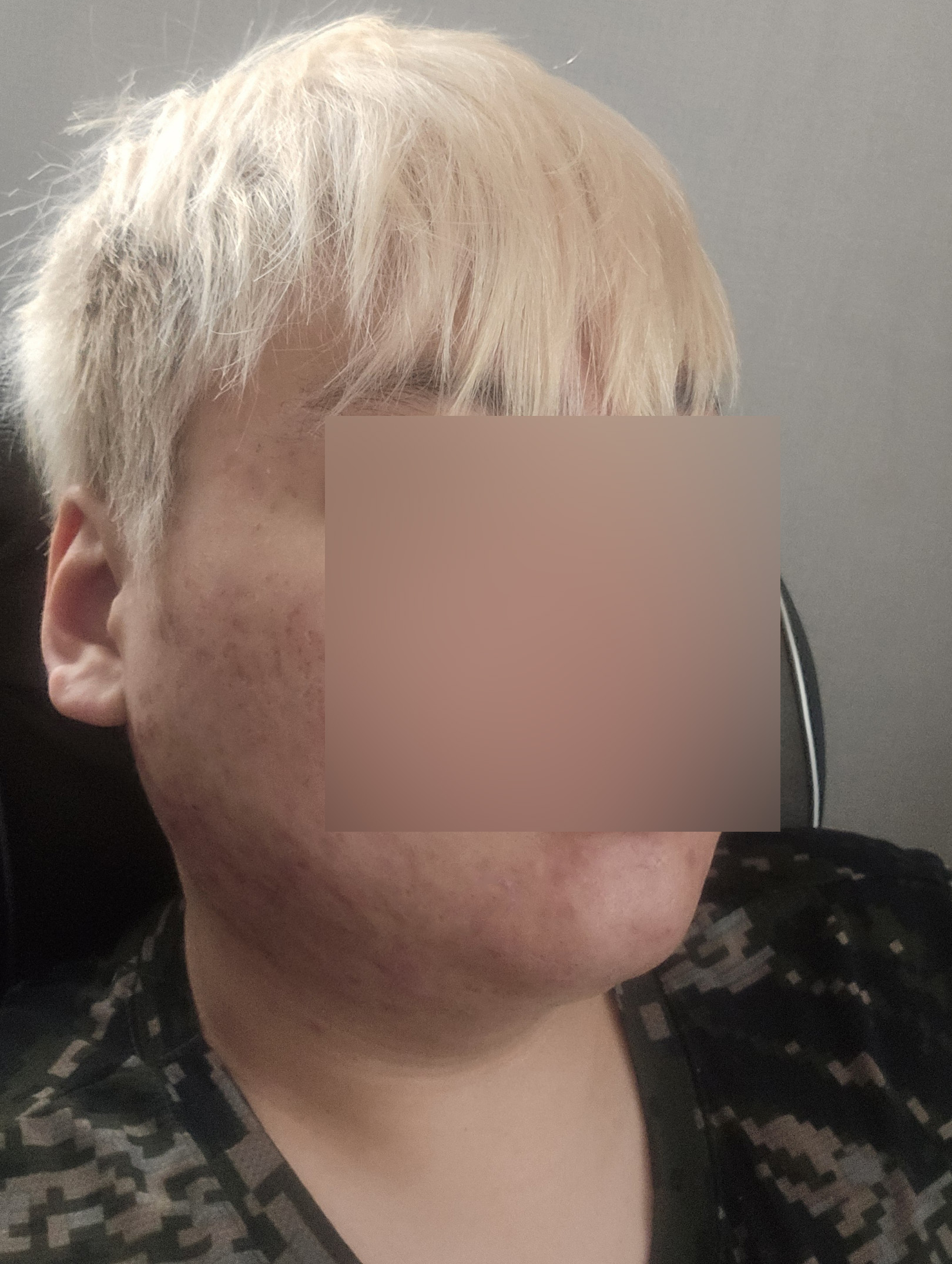 얼굴지방흡입 2달차 지방 잘 빠진 거 같습니다
