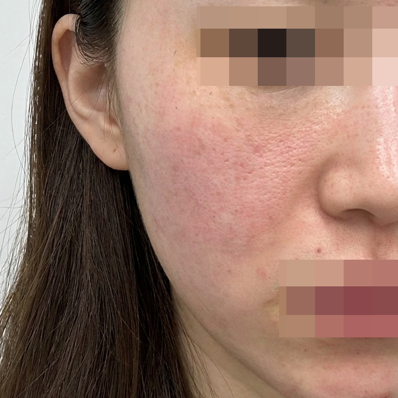 근본적인 피부 건강 챙기려고 받은 엑소좀, 너무 잘 맞아요!!