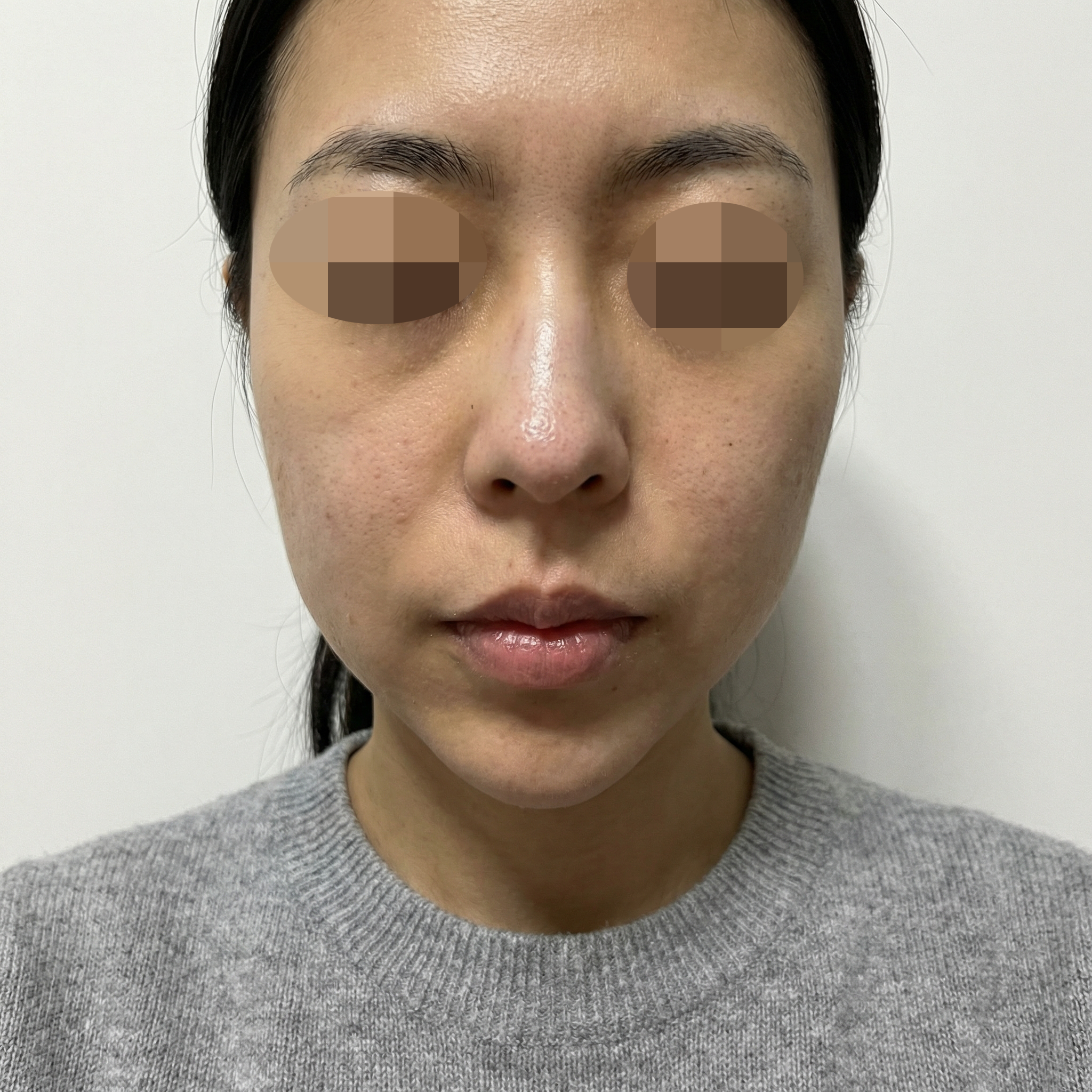 턱밑 라인 고민이라 받았는데 좋아서 계속 다닐 것 같아요~