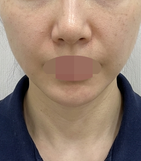 피부 고민으로 리투오 받았는데 3일차부터 벌써 달라진 것 같아요~