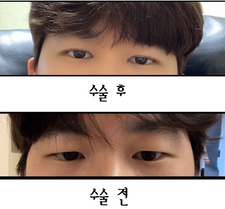 눈수술 후기