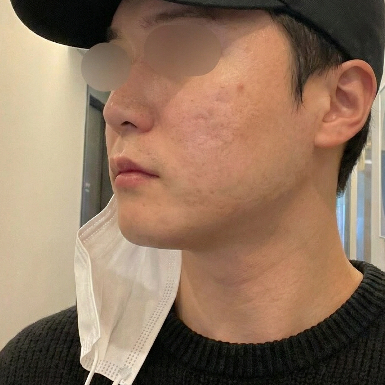 겨울철 푸석한 피부 관리하러 리쥬란 받고 왔습니다.