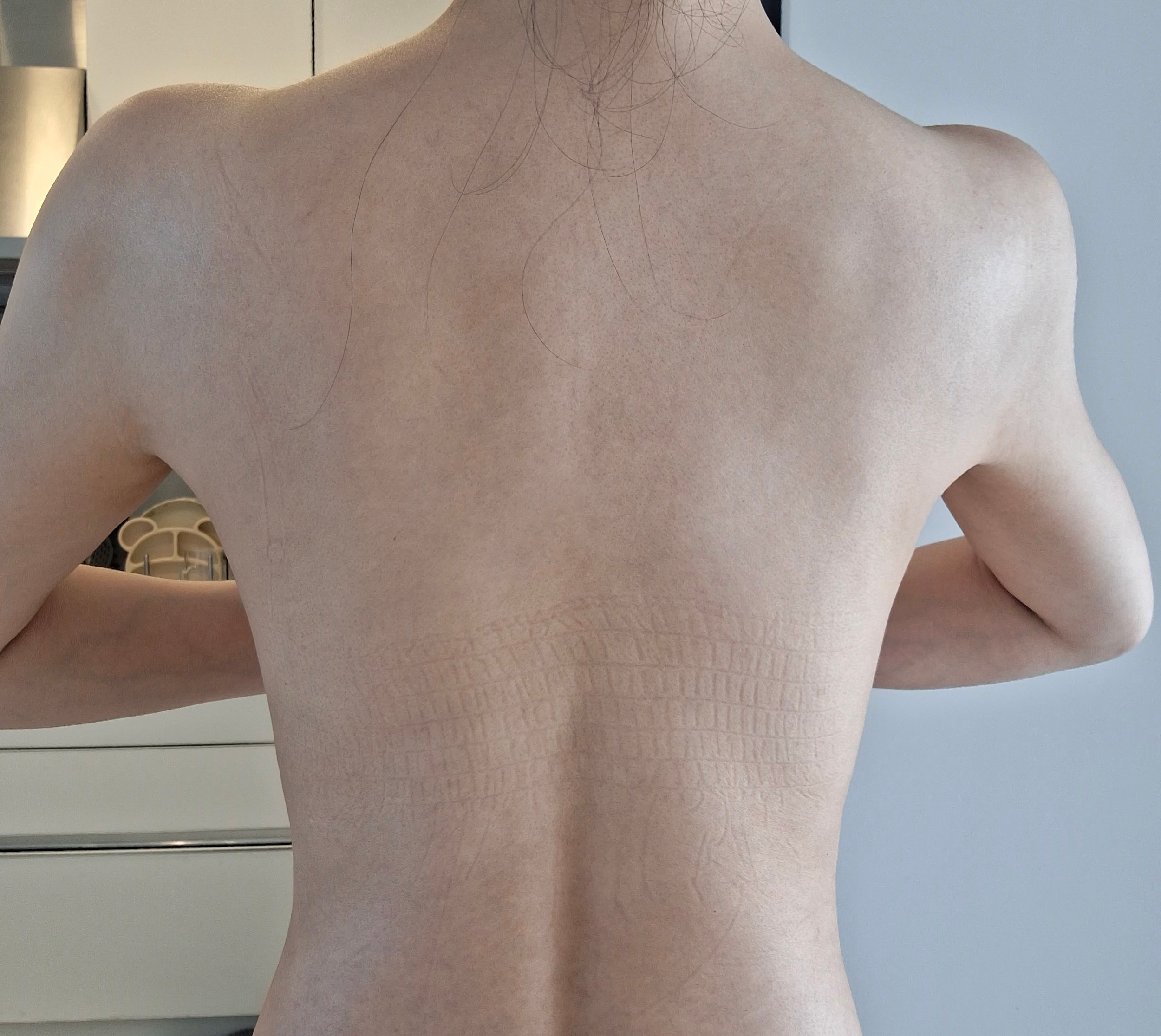 서울아이 브라라인 지방흡입 2달차, 생각보다 편했던 회복!
