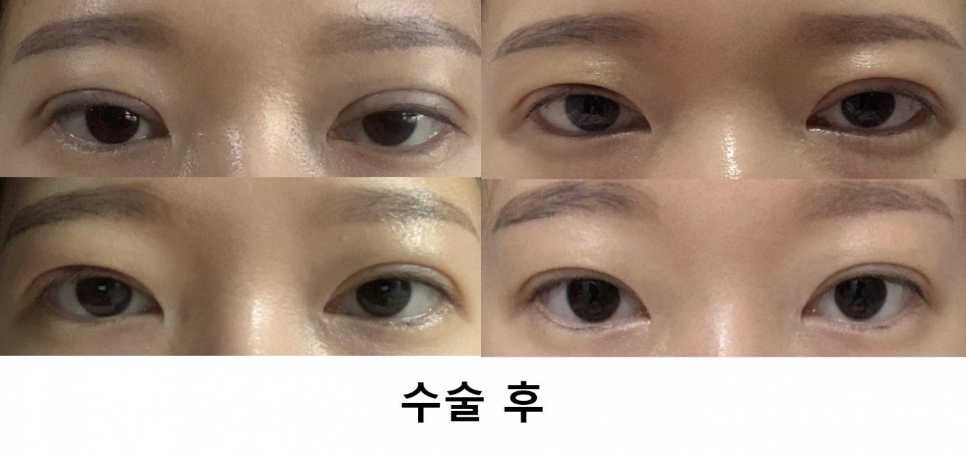 눈재수술 - 부분절개