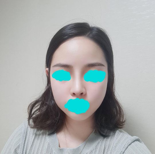수술 1달 후기