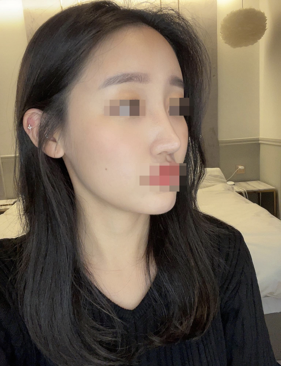 엄청 자연스럽게 콤플렉스가 개선되서 만족합니다 !