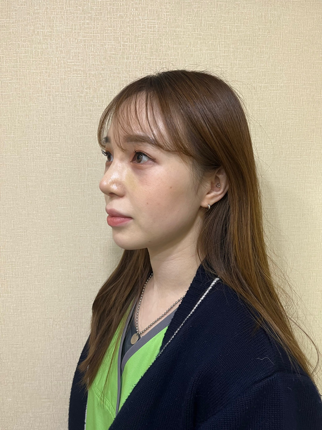 이쁜 코 만들어주신 원장님께 너무 감사해요~!!