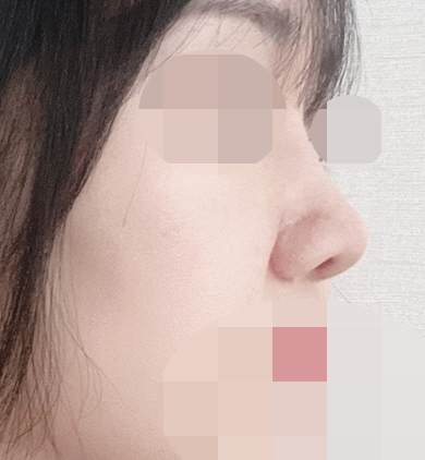 코 끝이 뭉뚝하고 들려있는 느낌때문에 그 부분을 개선하고 싶어서 수술을 결심했습니다.
