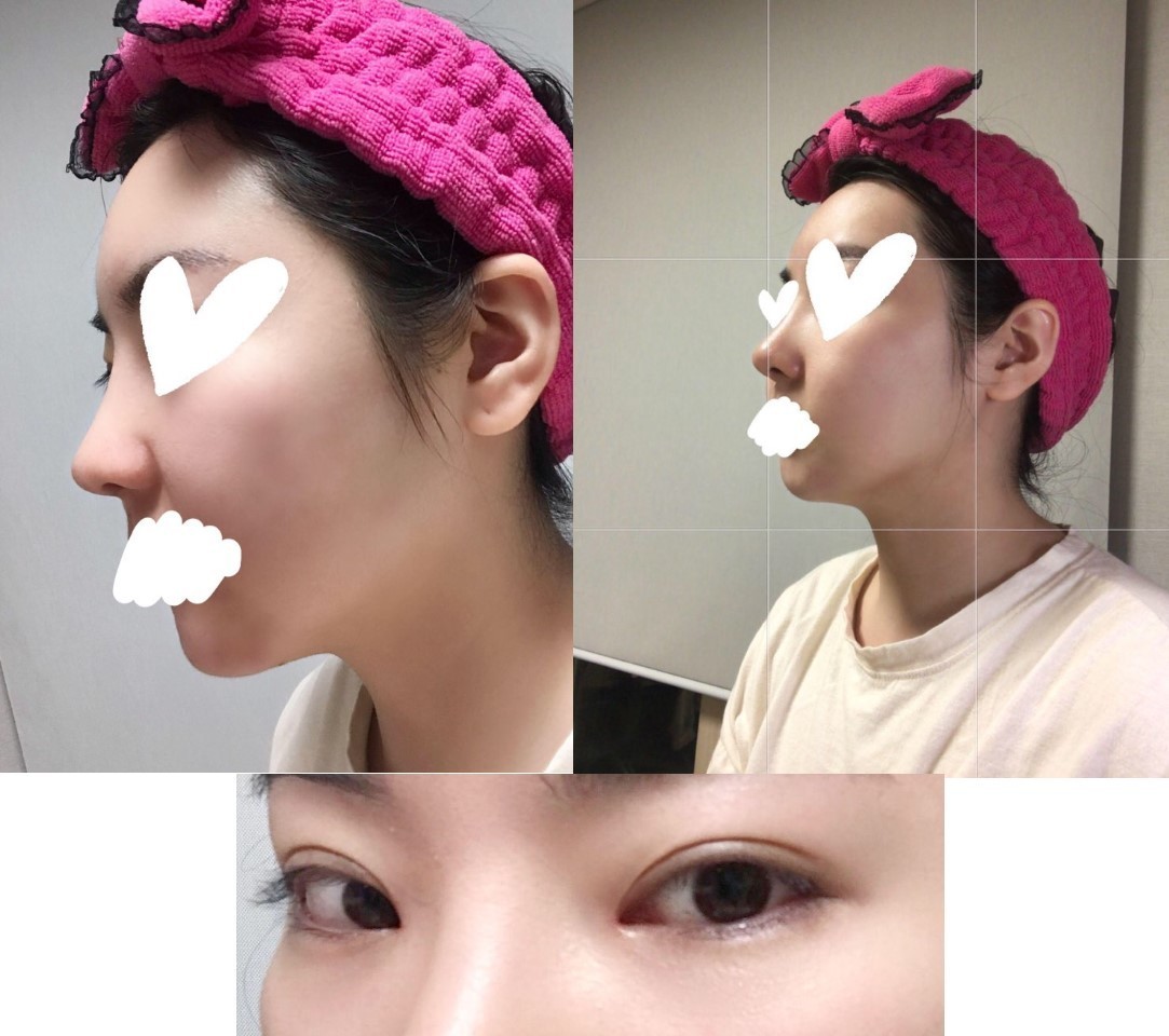 눈코지 한달 됐어요!!!