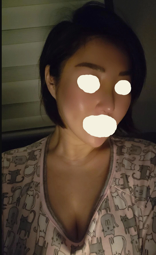 서울아이에서 코수술 한지 일주일 되는 날이에요.